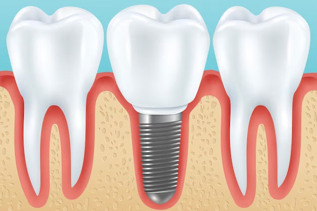 What Are Dental Implants?