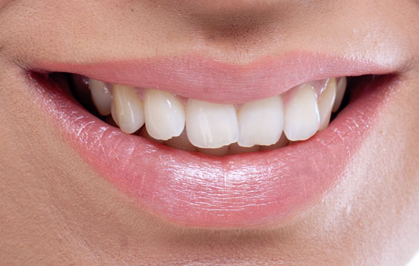 What Is An Impacted Tooth?